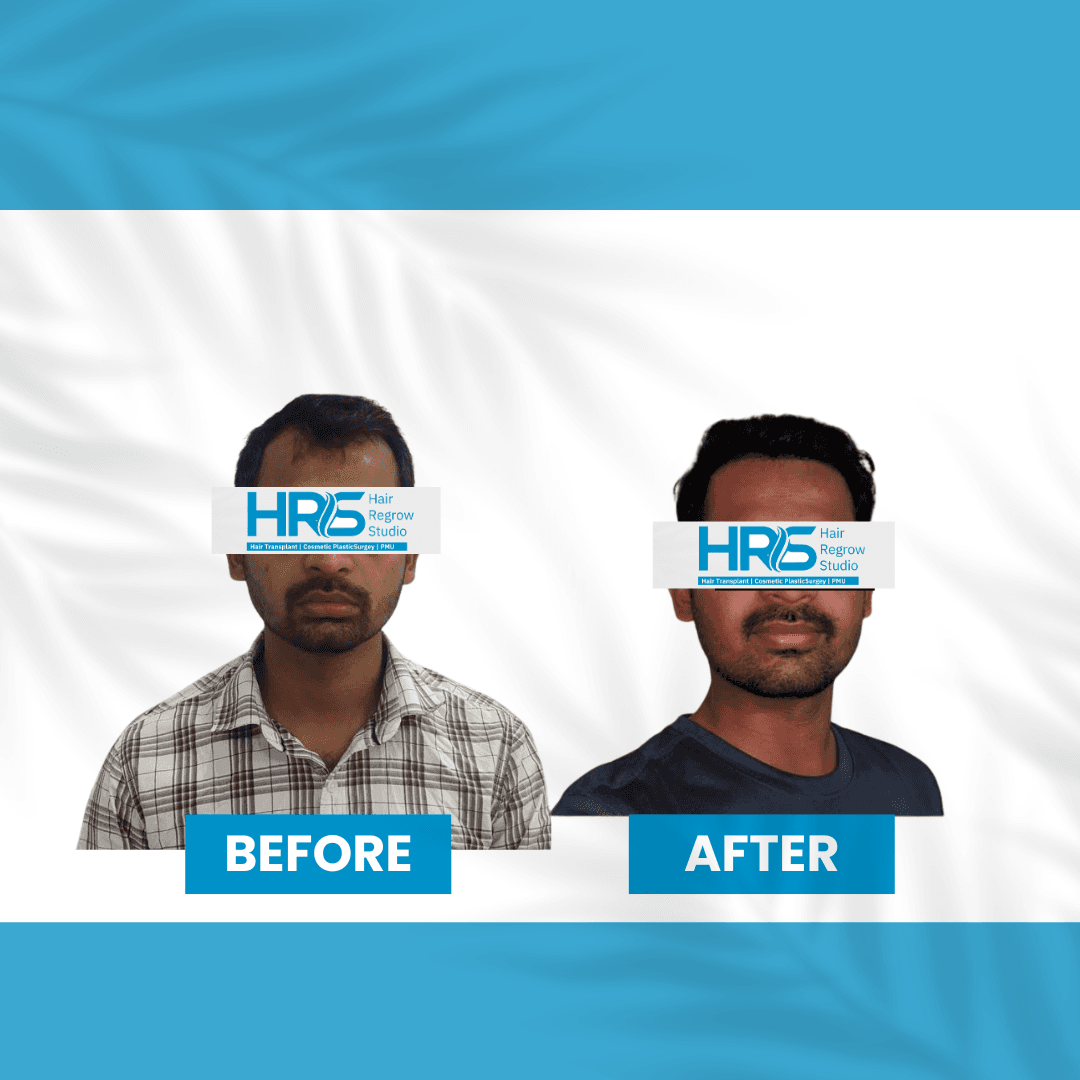 Hair restoration result — Patient 1