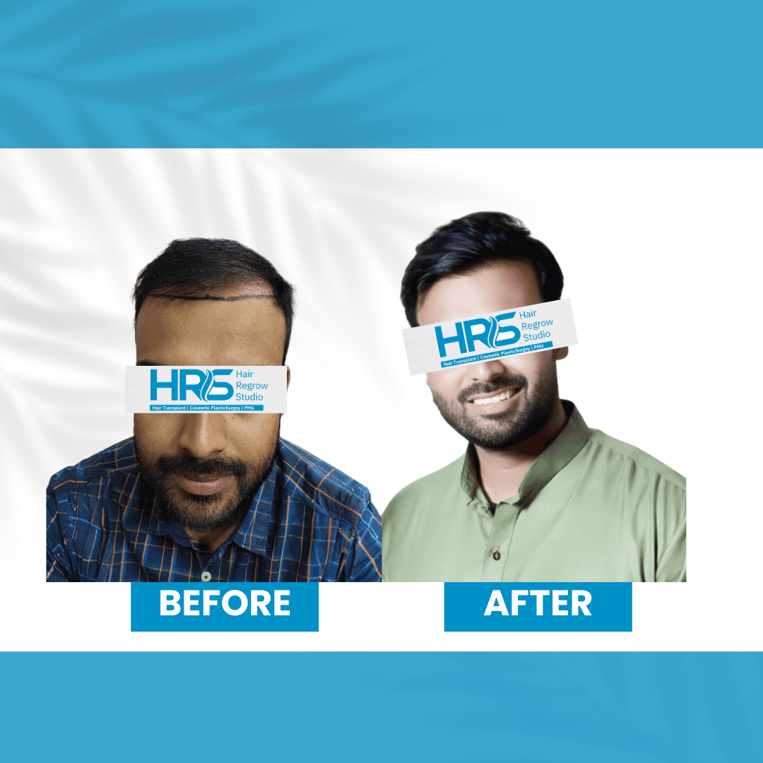 Hair restoration result — Patient 2