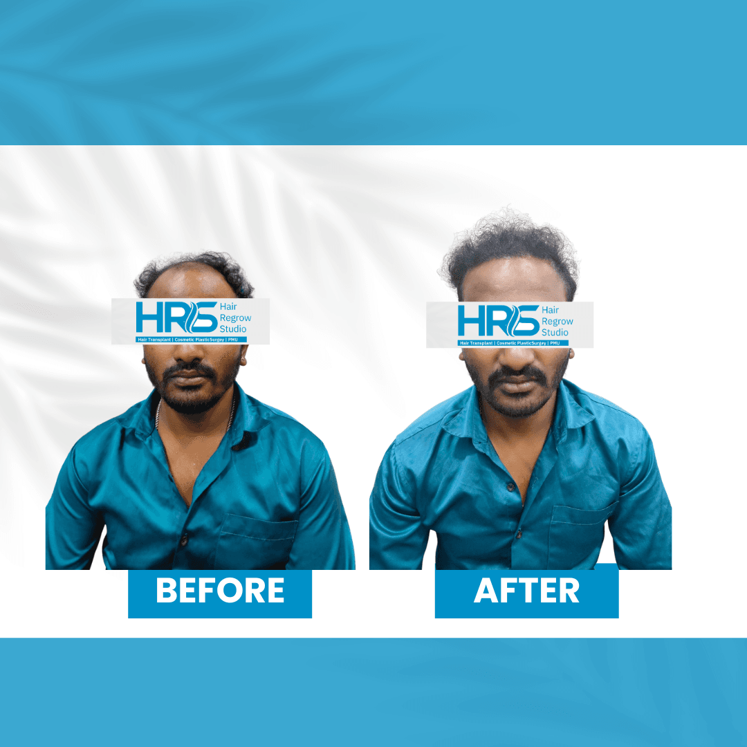 Hair restoration result — Patient 3
