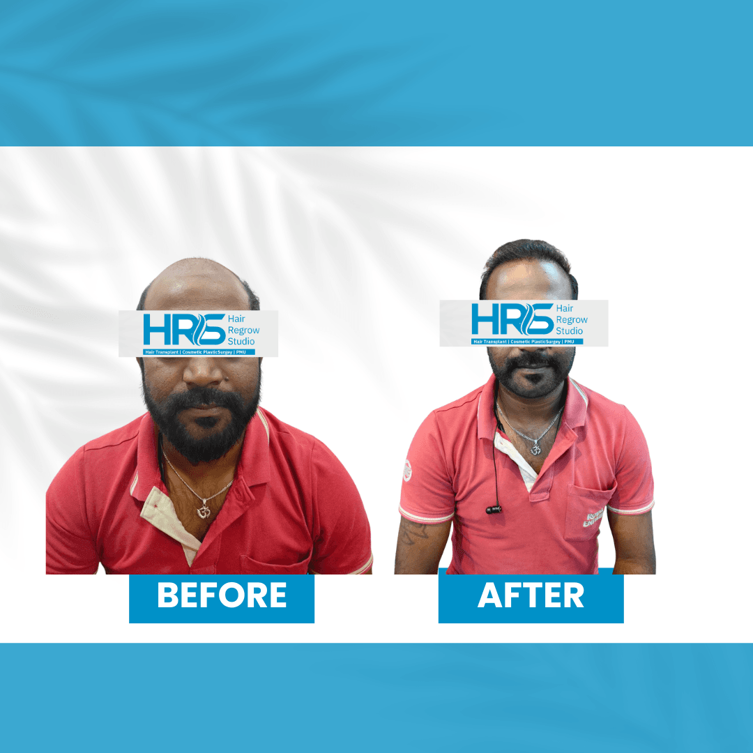 Hair restoration result — Patient 6