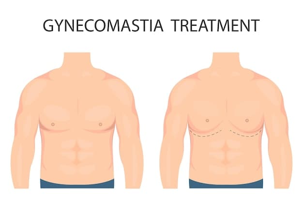 Gynecomastia Surgery